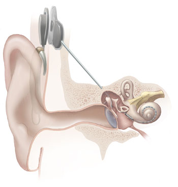 http://www.wikinfo.org/upload/6/6e/Cochlear_implant-1-.jpg